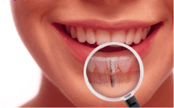 Dental Implant Diagram