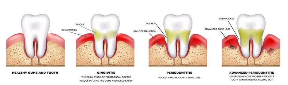 Periodontal Treatment Diagram