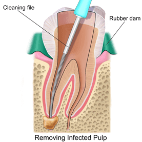 Root Canal