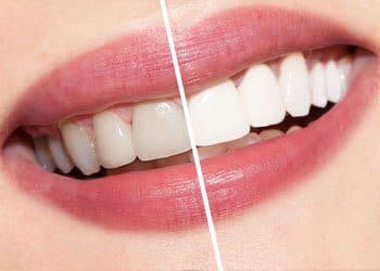 Teeth Whitening