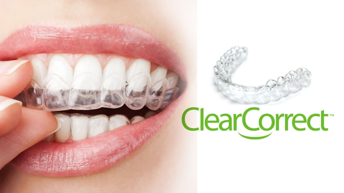ClearCorrect invisible aligners